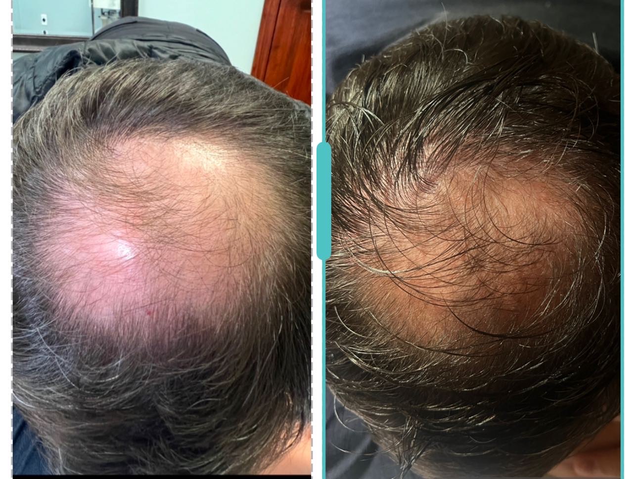 Hair Restoration Services in Plymouth, MI | PCR Centers - image0%20(1)