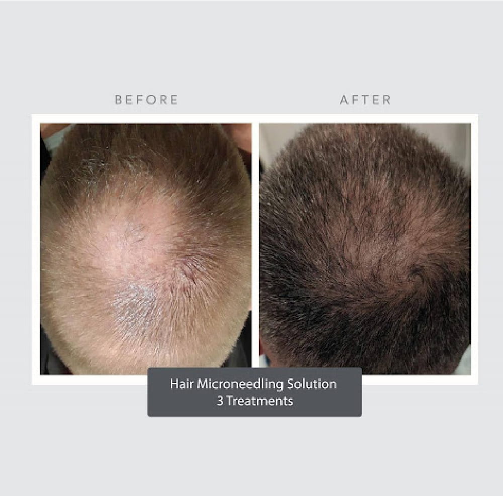 Hair Restoration Services in Plymouth, MI | PCR Centers - hair-1